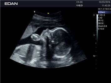 EDAN Acclarix LX25