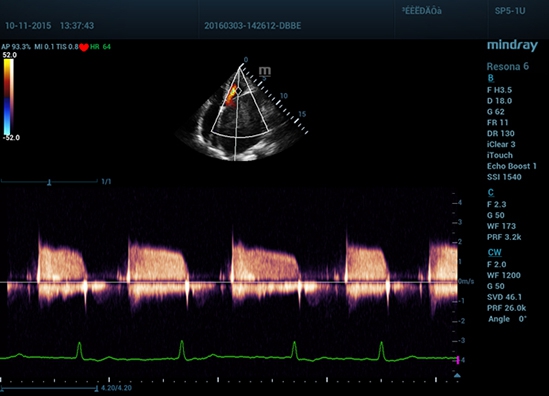 Mindray Resona 6